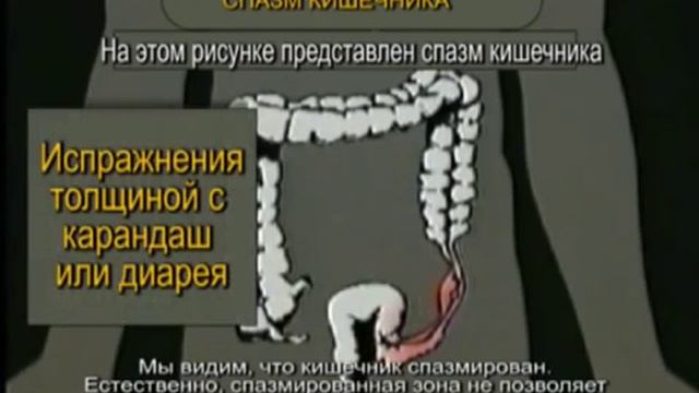Спазм кишечника что это. Спазм кишечника что это. Болит желудок и газообразование. Диета при срк. Спазм кишечника что это.