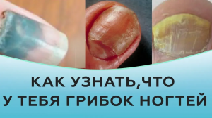 Как узнать, что у тебя грибок ногтей