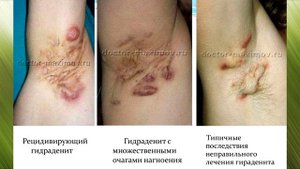 Гидраденит под мышкой причины и лечение. Как лечить гидраденит в домашних условиях. Полезные советы