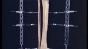 dispositivo universal de Profesor Ilizarov Испанский -универсальный аппарат профессора Илизарова