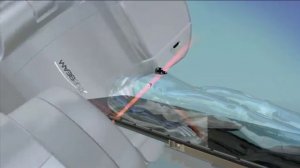 Лучевая терапия Rapid Arc