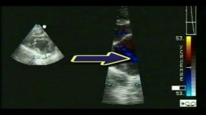 Тромбоз левого предсердия, митральный стеноз