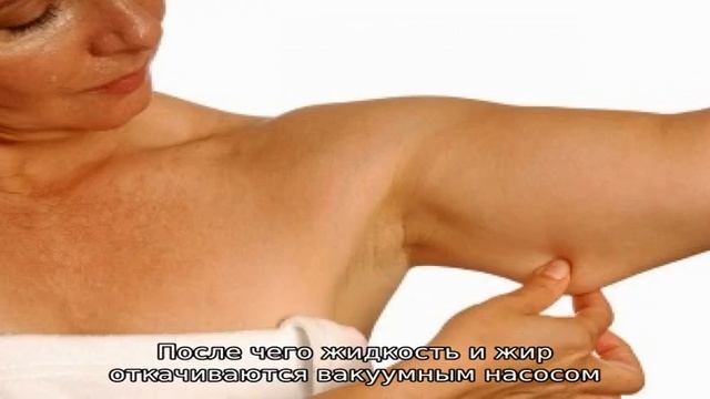 Что такое липосакция и ее виды