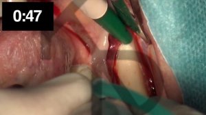 How we harvest a retromolar bone block with the Microsaw in only 1’34’’