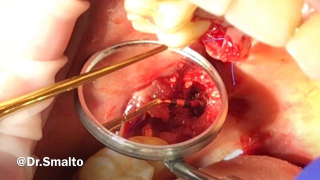 Sinus lifting/Закрытый Синус-лифтинг