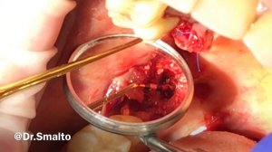 Sinus lifting/Закрытый Синус-лифтинг