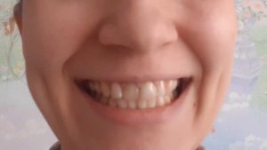 Упражнение лягушка. Артикуляционная гимнастика. Занятие с логопедом.