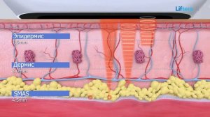 Смас лифтинг на аппарате Лифтера