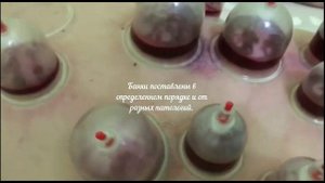 Сахарный диабет лечится хиджамой