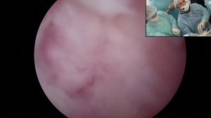 Мастер класс по лазерной энуклеации аденомы простаты (Мазуренко Д.А. г. Краснодар)