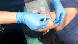 шугаринг верхняя губа