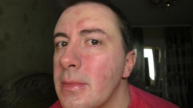 История о том как я лечил розацеа