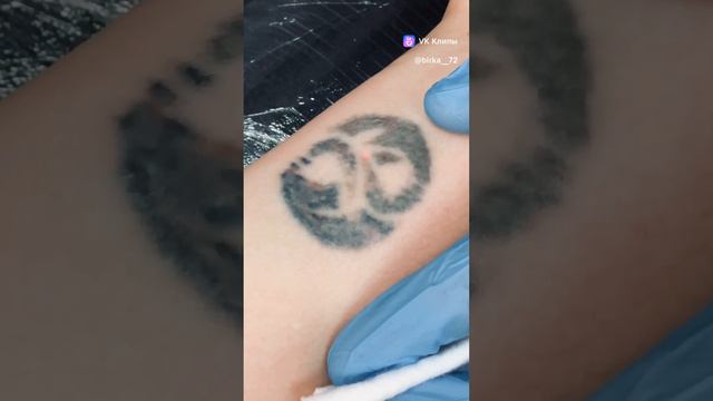 💥 Удаление татуировок лазером.