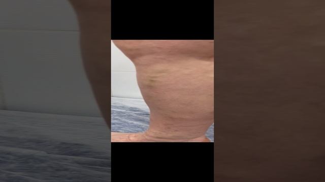 Варикоз , рецидив. Как лечить варикоз? Флеболог Москва. Флеболог. Сосудистый хирург. смотреть онлайн