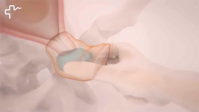 Введение акушерского пессария Арабин смотреть онлайн