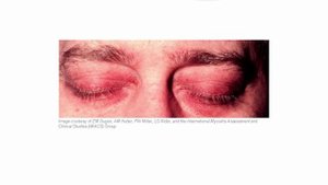 USMLE RX - 8.Анатомия - 3.Патология - 16.Полимиозит и дерматомиозит