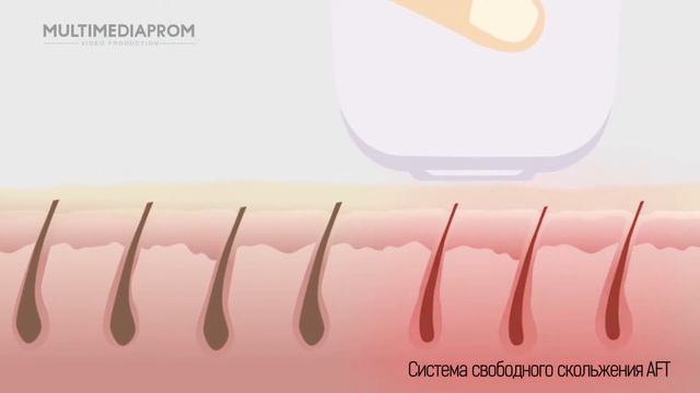 Обзорный ролик фотоэпилятора PLANTA смотреть онлайн