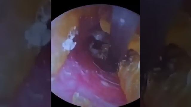 Удаление ушной пробки— избыточного скопление секрета. смотреть онлайн