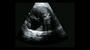 4. Аномалия Эбштейна у плода (Ebstein's anomaly in fetus)