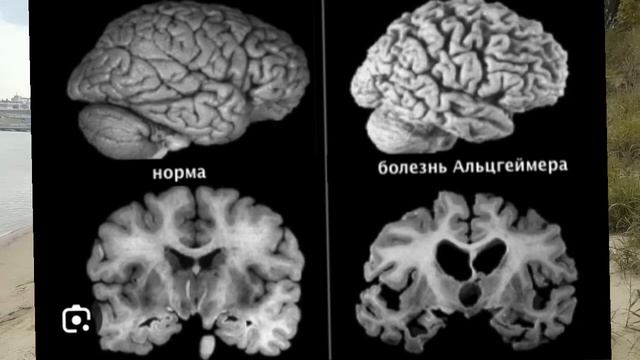 Как убежать от деменции? В темпе вальса!Не давайте мозгу лениться, следите за здоровьем? смотреть онлайн