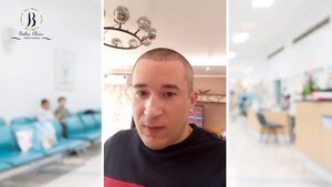 10 дней после пересадки волос в Bellus Clinic