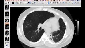 STR Cardiothoracic Case Webinar 3/1/2018