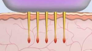 Как работе RF микронидлинг в аппарате Dermapen RFN с изолированными иглами