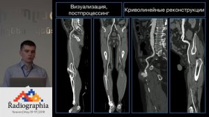 Практические аспекты в КТ-ангиографии сосудов нижних конечностей