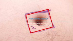 5 д смас лифтинг для удаления морщины и подтяжки кожи