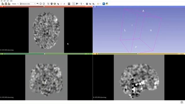 Detecção de Autismo com Python utilizando imagens de ressonância magnética (rs-fMRI) смотреть онлайн