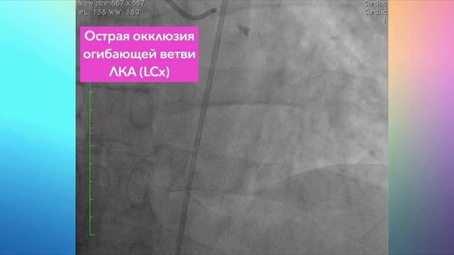 Клинический случай: острый инфаркт миокарда нижней стенки с элевацией сегмента ST