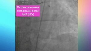 Клинический случай: острый инфаркт миокарда нижней стенки с элевацией сегмента ST