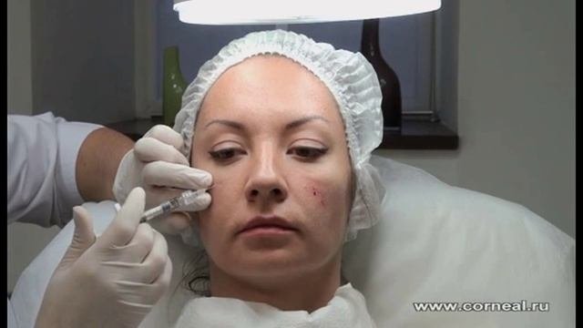 Принцесс Филлер во всех отношениях удобный препарат