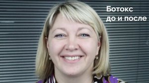До и после | ботокс между бровей и лоб | ксеомин,  диспорт, ботекс | косметология самара