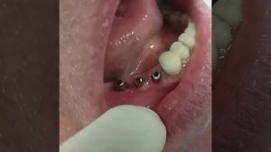 Протезирование на имплантах. Нижняя челюсть справа. Металокерамика.