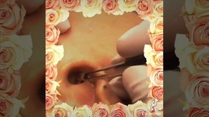 угри в ухе! чистка ушей!