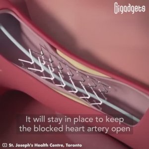 Баллонная ангиопластика (2023)