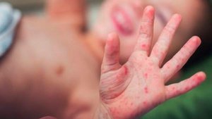 Крупный очаг заражения корью образовался в Дагестане из-за падения коллективного иммунитета