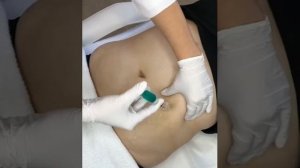 Инъекции Липолитиков для Живота в Краснодаре