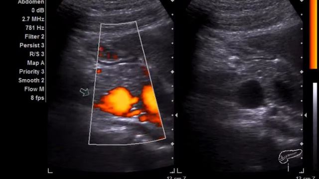 УЗИ ОБП.wmv смотреть онлайн