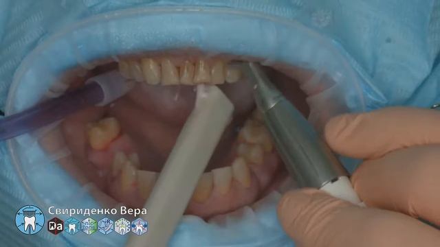 Professional oral hygiene -case 010 Acteon DTE Dentsply Coxo Floweis 3M KerrHawe (FHD multistream)