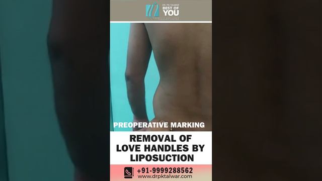 How To Get Rid Of Flanks (Love Handles) | Removal of Love Handles with Liposuction | Dr. PK Talwar