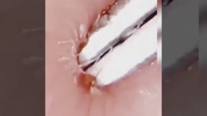 Выдавливание угрей.