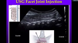 HEAD & NECK PAIN Ultrasound Guided USG INTERVENTION: DR NEERAJ JAIN MBBS, MD, FIMSA, CIPS, FIPP(USA