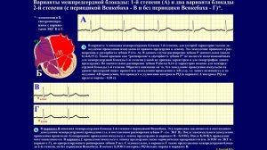 Тема 28.2. Блокады сердца. Межпредсердные (внутрипредсердные) блокады