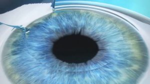 Femto LASIK (Фeмто ЛАСИК) - Лазерная Коррекция Зрения