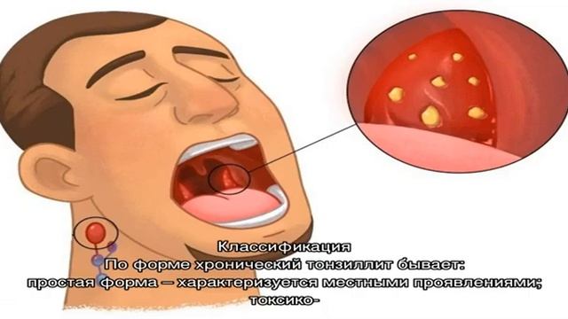 Чем отличается тонзиллит от ангины