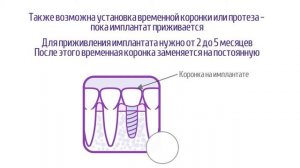 Одномоментная имплантация зубов
