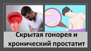 Скрытая гонорея и хронический простатит