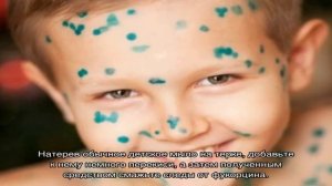 Фукорцин при ветрянке